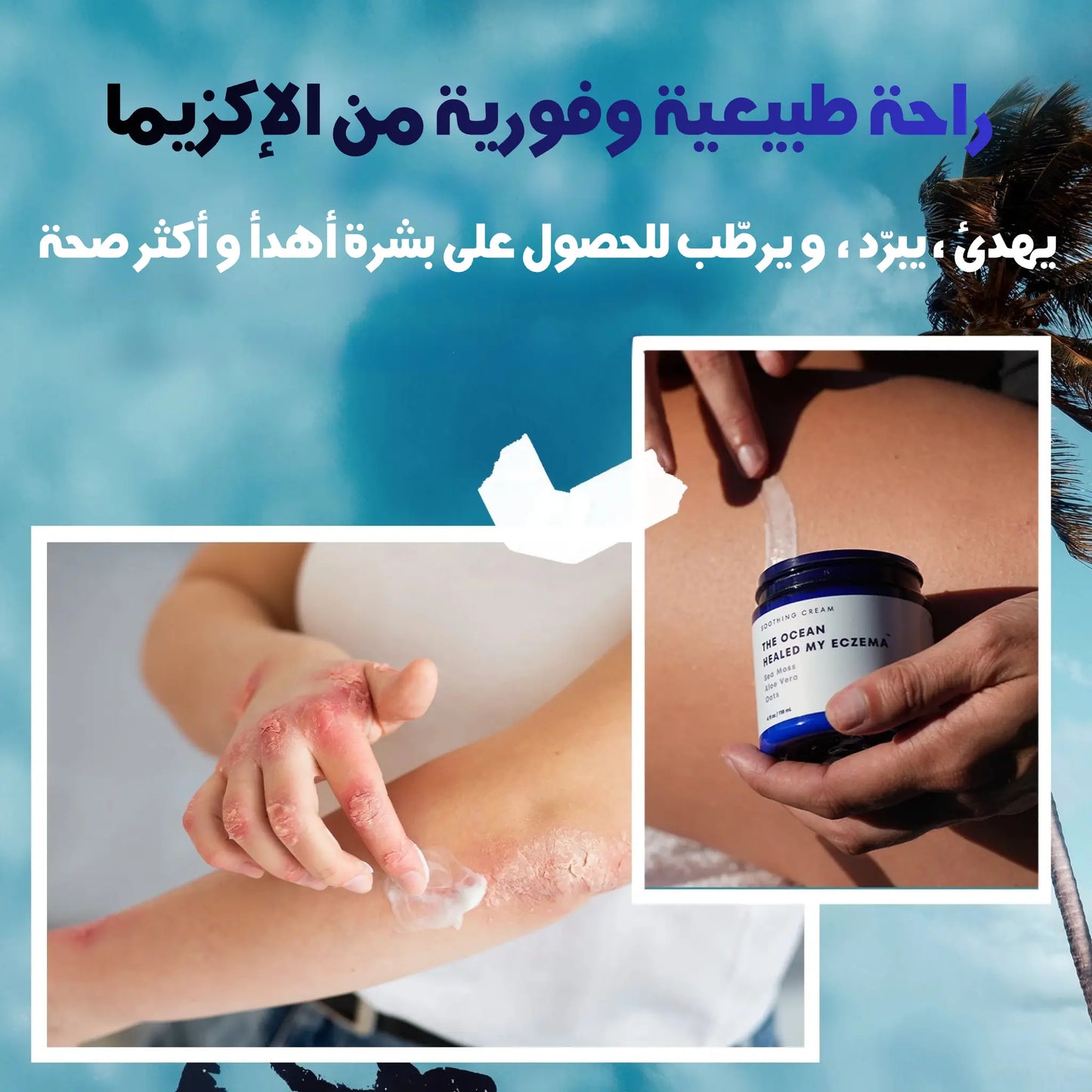 eczema topical cream