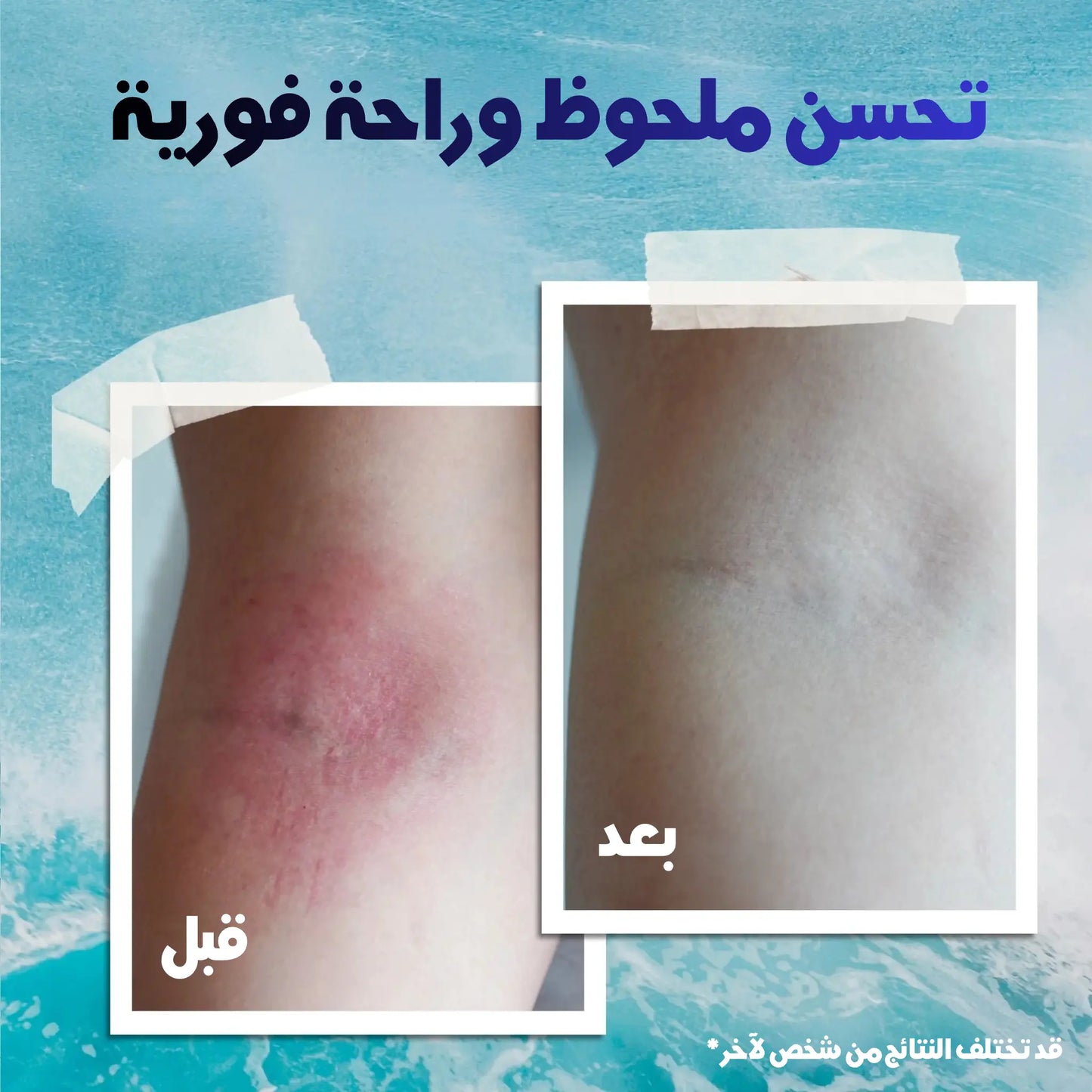 eczema topical cream