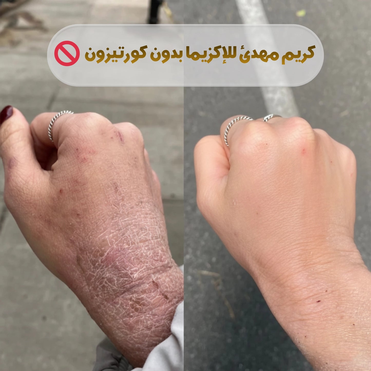 eczema topical cream